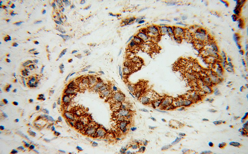 Immunohistochemical of paraffin-embedded human pancreas cancer using Catalog No:117088(B3GALT4 antibody) at dilution of 1:100 (under 40x lens)