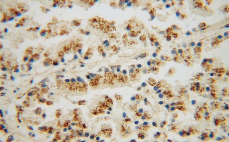 Immunohistochemical of paraffin-embedded human prostate using Catalog No:109932(DHX36 antibody) at dilution of 1:50 (under 40x lens)