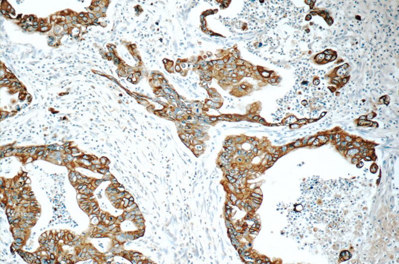 Immunohistochemistry of paraffin-embedded human pancreas cancer tissue slide using Catalog No:109801(KRT19 Antibody) at dilution of 1:100 (under 10x lens)
