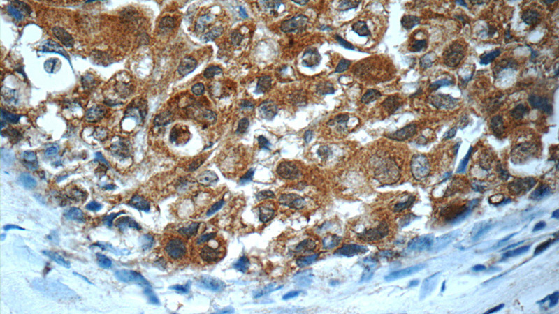 Immunohistochemistry of paraffin-embedded human breast cancer slide using Catalog No:110217(EGFR Antibody) at dilution of 1:50