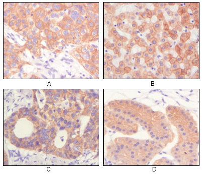 Immunohistochemical analysis of paraffin-embedded human lung squamous cell carcinoma (A),normal hepatocyte (B), colon adenocacinoma?, normal stomach tissue (D), showing cytoplasmic and membrane localization using CK mouse mAb with DAB staining.