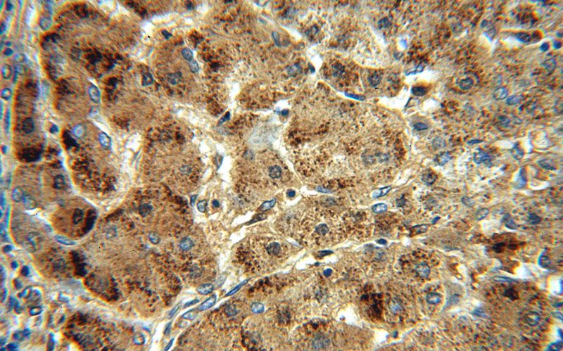 Immunohistochemical of paraffin-embedded human hepatocirrhosis using Catalog No:108885(CAT-Specific antibody) at dilution of 1:100 (under 40x lens)