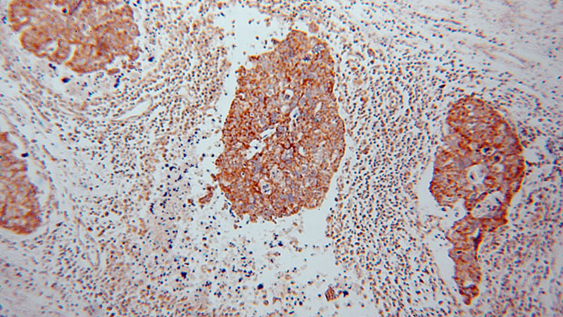 Immunohistochemical of paraffin-embedded human ovary tumor using Catalog No:112828(MRPL44 antibody) at dilution of 1:50 (under 10x lens)