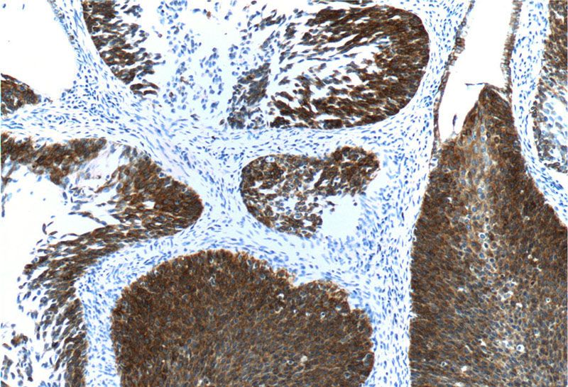 Immunohistochemistry of paraffin-embedded human cervical cancer tissue slide using Catalog No:109795(KRT16 Antibody) at dilution of 1:200 (under 10x lens)