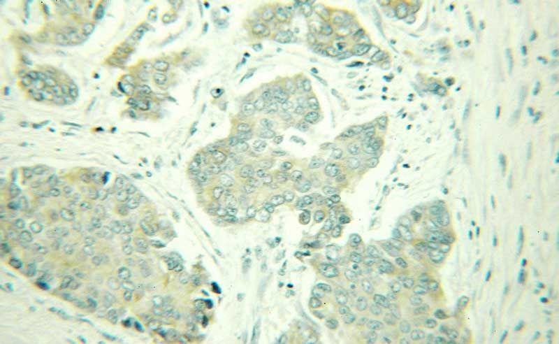 Immunohistochemical of paraffin-embedded human breast cancer using Catalog No:115099(DHCR24 antibody) at dilution of 1:100 (under 25x lens)