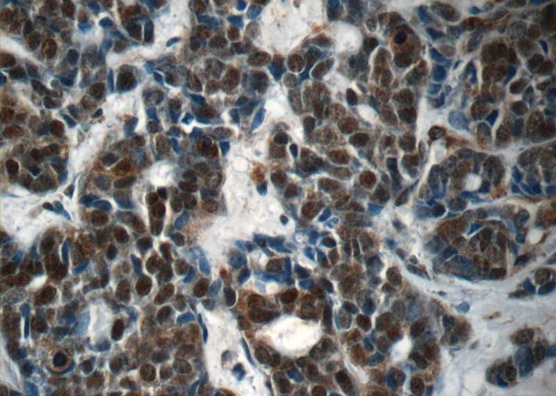 Immunohistochemistry of paraffin-embedded human cervical cancer tissue slide using Catalog No:114607(RBM25 Antibody) at dilution of 1:50 (under 40x lens)