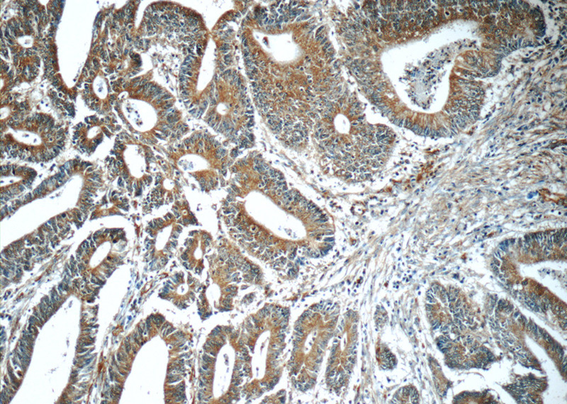 Immunohistochemistry of paraffin-embedded human colon cancer tissue slide using Catalog No:111352(HIP1 Antibody) at dilution of 1:50 (under 10x lens)