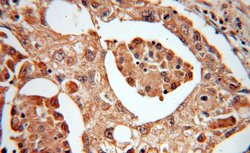 Immunohistochemical of paraffin-embedded human lung cancer using Catalog No:112775(NUDT1 antibody) at dilution of 1:50 (under 40x lens)