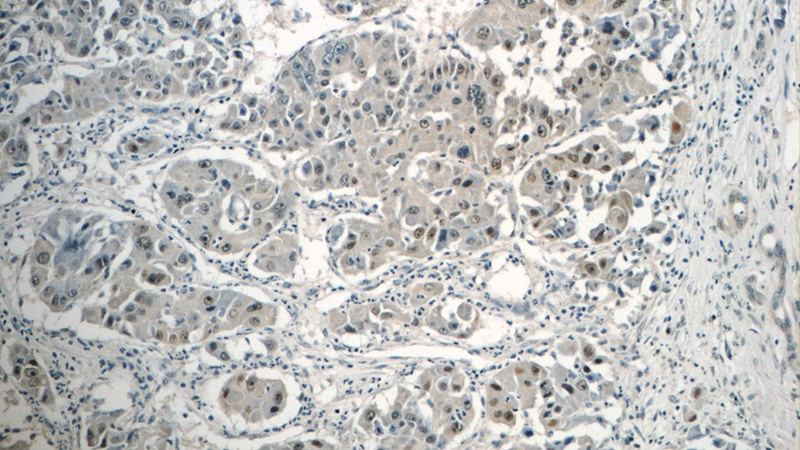 Immunohistochemistry of paraffin-embedded human liver cancer tissue slide using Catalog No:116416(TRPT1 Antibody) at dilution of 1:50 (under 10x lens)