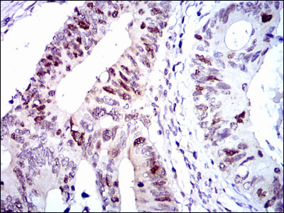 Immunohistochemical analysis of paraffin-embedded colon cancer tissues using CDK2 mouse mAb with DAB staining.
