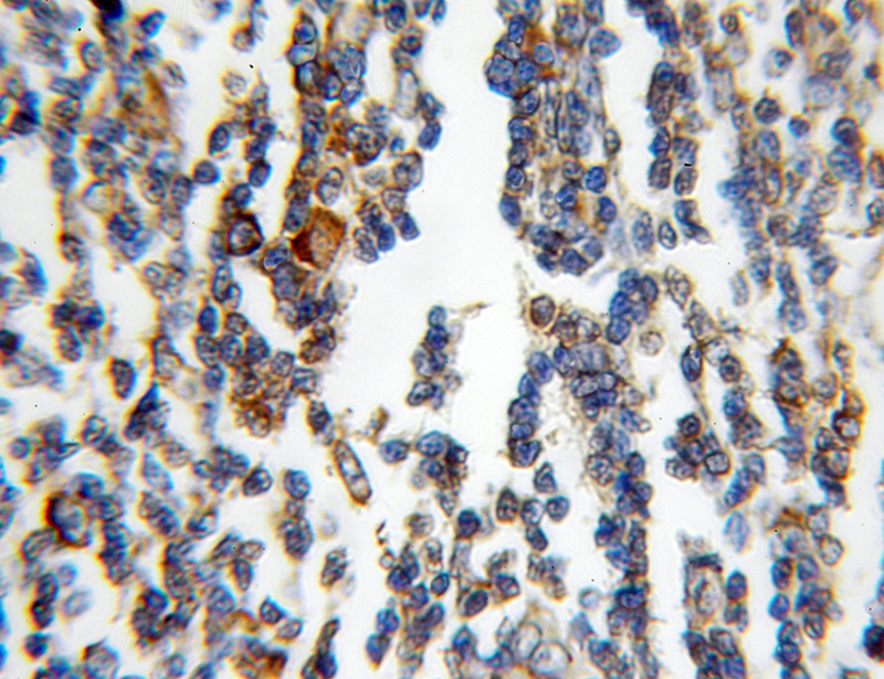 Immunohistochemical of paraffin-embedded human lymphoma using Catalog No:114696(RPL4 antibody) at dilution of 1:100 (under 10x lens)