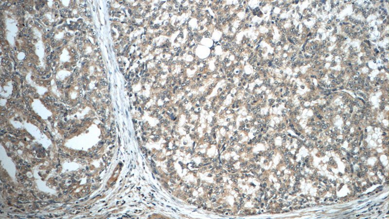 Immunohistochemistry of paraffin-embedded human prostate cancer tissue slide using Catalog No:110826(GAGE7 Antibody) at dilution of 1:50 (under 10x lens)