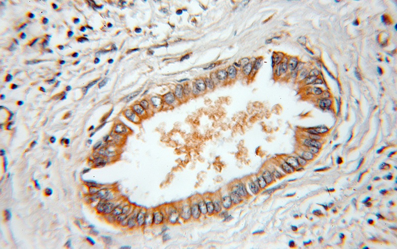 Immunohistochemical of paraffin-embedded human pancreas cancer using Catalog No:109105(CDC42 antibody) at dilution of 1:50 (under 25x lens)