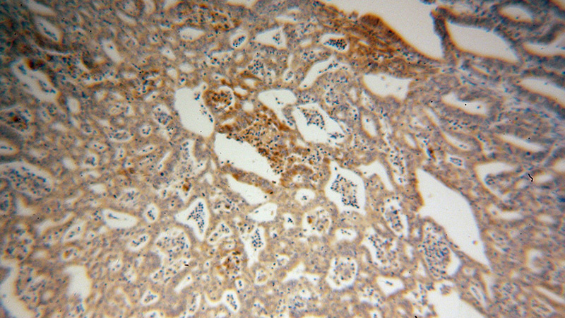 Immunohistochemical of paraffin-embedded human endometrial cancer using Catalog No:113586(PARN antibody) at dilution of 1:100 (under 10x lens)