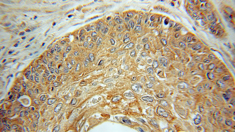 Immunohistochemical of paraffin-embedded human cervical cancer using Catalog No:110234(SCYE1 antibody) at dilution of 1:100 (under 10x lens)