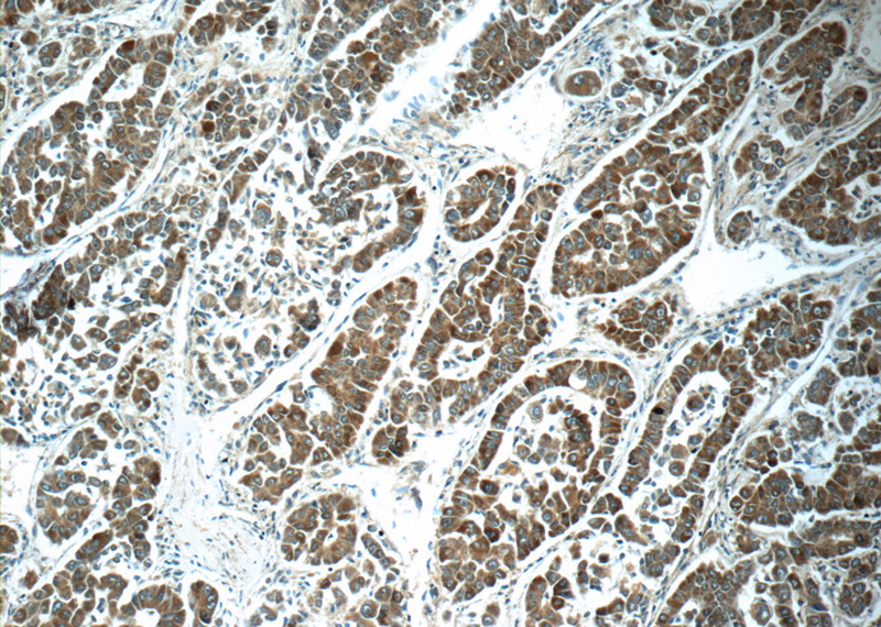 Immunohistochemistry of paraffin-embedded human liver cancer tissue slide using Catalog No:107818(ABL2 Antibody) at dilution of 1:50 (under 10x lens)