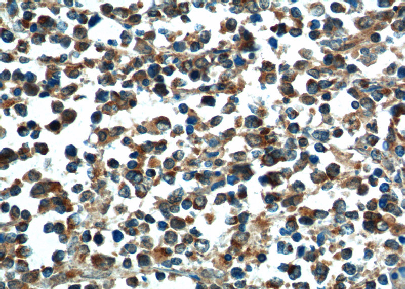 Immunohistochemistry of paraffin-embedded human lymphoma tissue slide using Catalog No:108364(BAX Antibody) at dilution of 1:200 (under 40x lens).