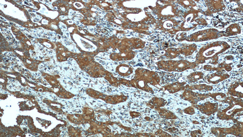 Immunohistochemistry of paraffin-embedded human lung cancer tissue slide using Catalog No:117189(BLoc1S3 Antibody) at dilution of 1:50 (under 10x lens)