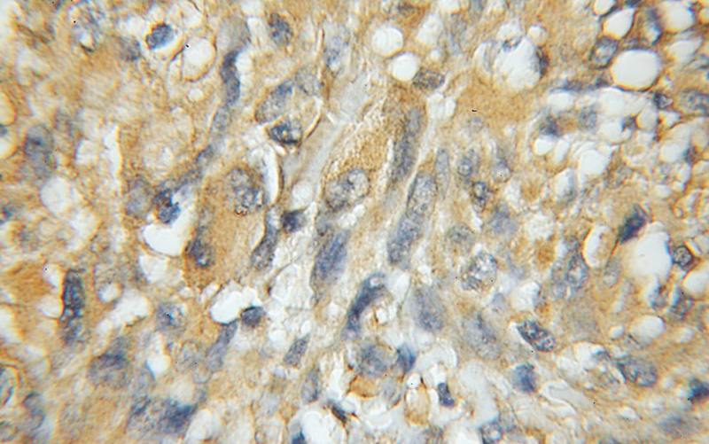 Immunohistochemical of paraffin-embedded human gliomas using Catalog No:109909(DGKA antibody) at dilution of 1:100 (under 10x lens)