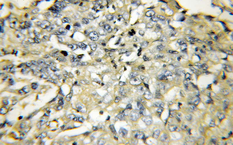 Immunohistochemical of paraffin-embedded human lung cancer using Catalog No:116708(VAMP5 antibody) at dilution of 1:50 (under 10x lens)
