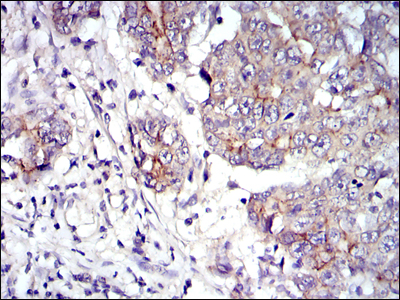 Immunohistochemical analysis of paraffin-embedded stomach cancer tissues using JUP mouse mAb with DAB staining.