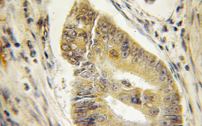 Immunohistochemical of paraffin-embedded human colon cancer using Catalog No:117114(Beclin 1 antibody) at dilution of 1:50 (under 10x lens)