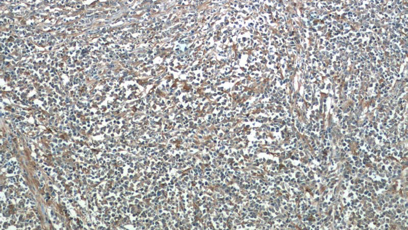 Immunohistochemistry of paraffin-embedded human lymphoma tissue slide using Catalog No:113783(PGD Antibody) at dilution of 1:50 (under 10x lens)