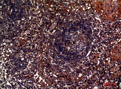 Fig2:; Immunohistochemical analysis of paraffin-embedded human-lymph, antibody was diluted at 1:100