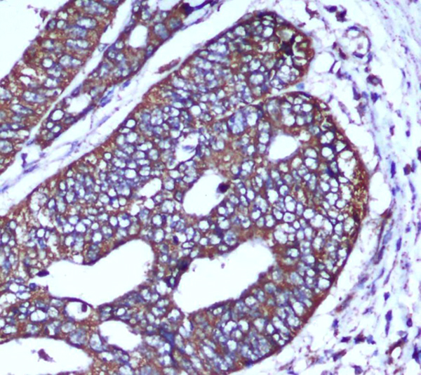 Immunohistochemical analysis of paraffin-embedded human colorectal carcinoma with COX IV Mouse mAb (4D11-B3-E8,1:50 diluted),showing cytoplasm localization.A high pressure mediated antigen retrieval step was performed in citrate buffer(pH6.0).