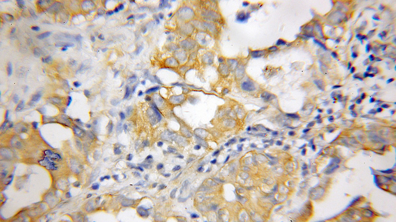 Immunohistochemical of paraffin-embedded human lung cancer using Catalog No:114266(PGDS antibody) at dilution of 1:50 (under 10x lens)