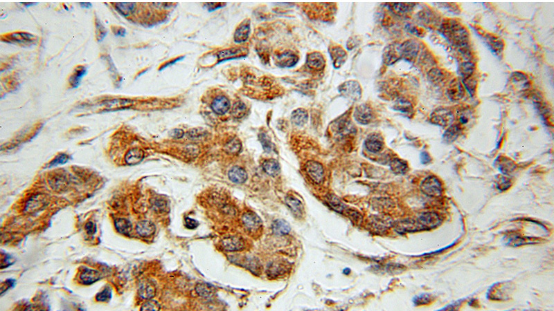 Immunohistochemical of paraffin-embedded human pancreas cancer using Catalog No:108920(CAMK2G antibody) at dilution of 1:100 (under 10x lens)