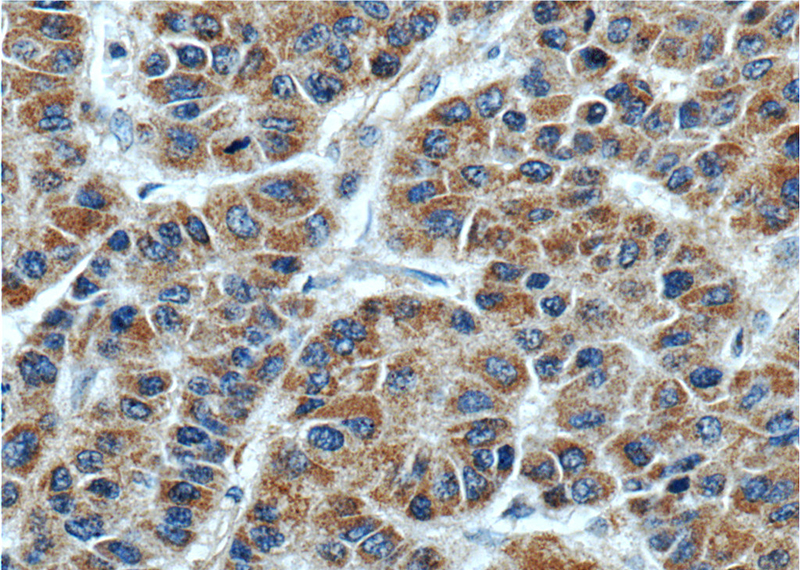 Immunohistochemistry of paraffin-embedded human liver cancer tissue slide using Catalog No:117197(BMP3 Antibody) at dilution of 1:50 (under 40x lens)