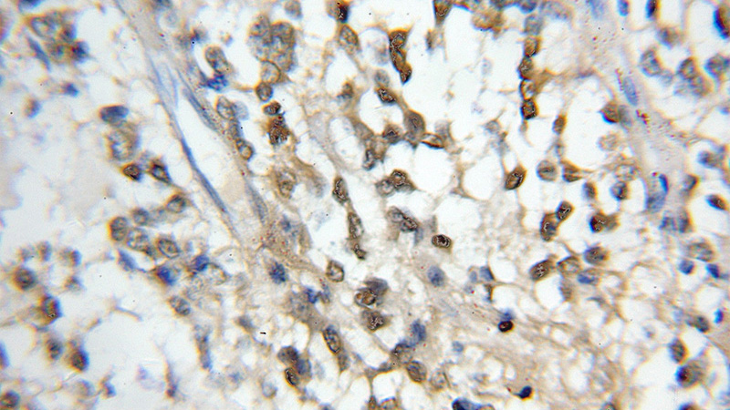 Immunohistochemical of paraffin-embedded human gliomas using Catalog No:108270(ASRGL1 antibody) at dilution of 1:50 (under 10x lens)
