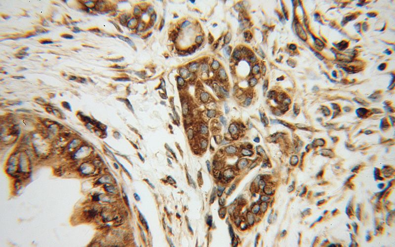 Immunohistochemical of paraffin-embedded human pancreas cancer using Catalog No:110314(EEF1D antibody) at dilution of 1:100 (under 40x lens)