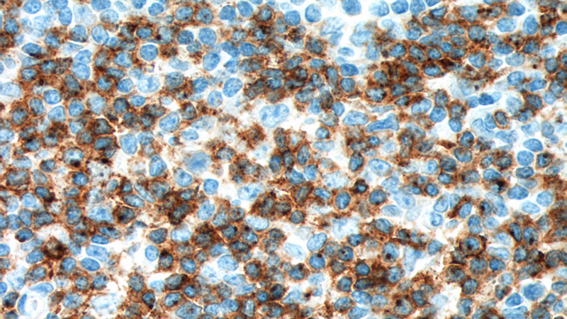 Immunohistochemistry of paraffin-embedded human tonsillitis tissue slide using Catalog No:109065(CD2 Antibody) at dilution of 1:200 (under 40x lens). Heat mediated antigen retrieved with Tris-EDTA buffer, pH9.0