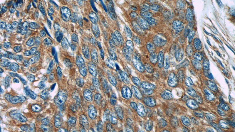Immunohistochemistry of paraffin-embedded human skin cancer tissue slide using Catalog No:112835(MRPL53 Antibody) at dilution of 1:50 (under 40x lens)