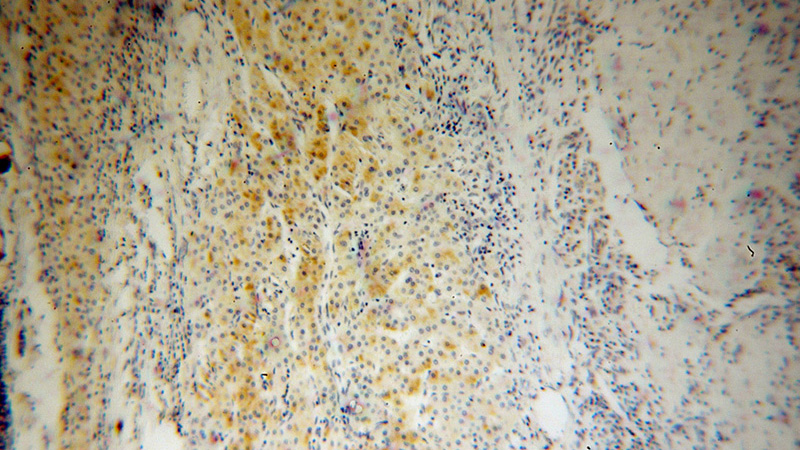 Immunohistochemical of paraffin-embedded human liver cancer using Catalog No:110400(ERAP2 antibody) at dilution of 1:50 (under 10x lens)