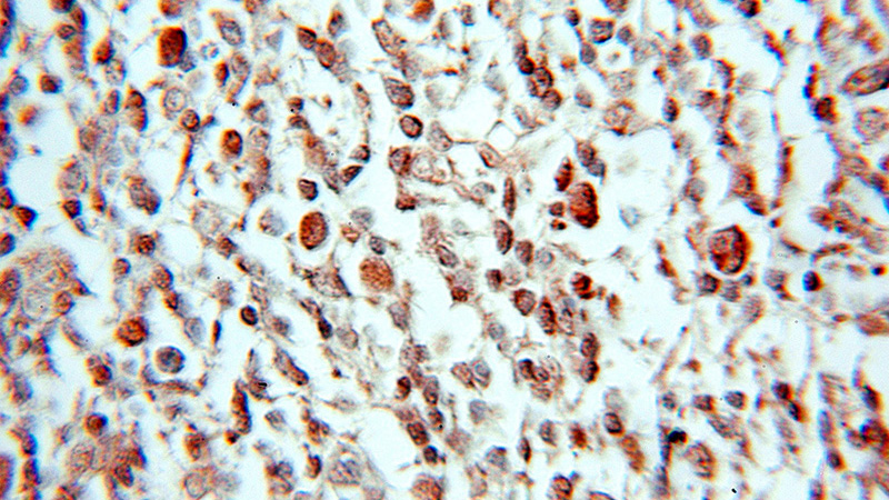 Immunohistochemical of paraffin-embedded human lymphoma using Catalog No:114079(PPAN antibody) at dilution of 1:50 (under 10x lens)