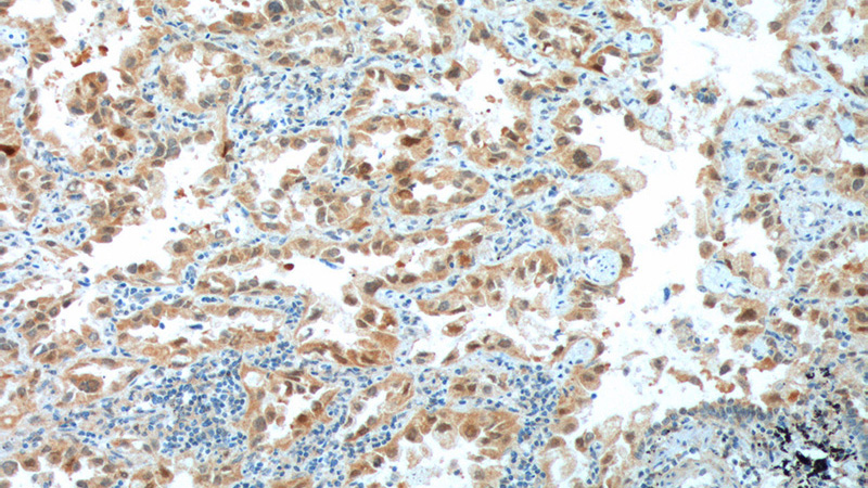 Immunohistochemistry of paraffin-embedded human lung cancer tissue slide using Catalog No:109161(CDK4 Antibody) at dilution of 1:200 (under 10x lens). heat mediated antigen retrieved with Tris-EDTA buffer(pH9).