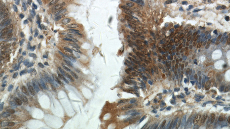 Immunohistochemical of paraffin-embedded human colon using Catalog No:111910(KANK2 antibody) at dilution of 1:100 (under 40x lens)