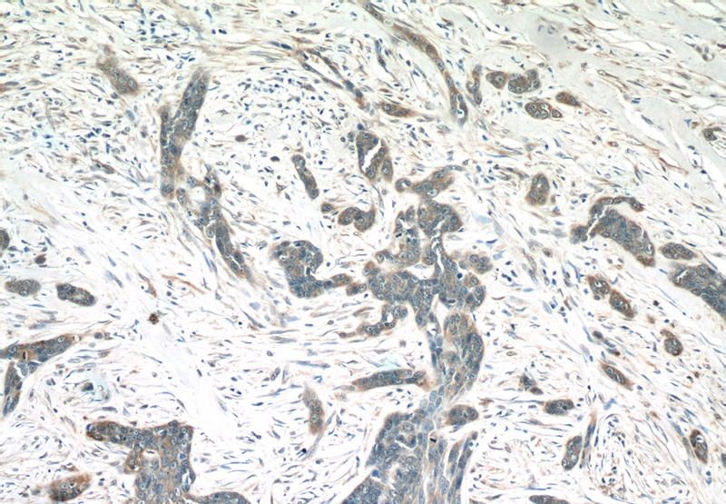Immunohistochemistry of paraffin-embedded human skin cancer tissue slide using Catalog No:112605(MIA Antibody) at dilution of 1:50 (under 10x lens)