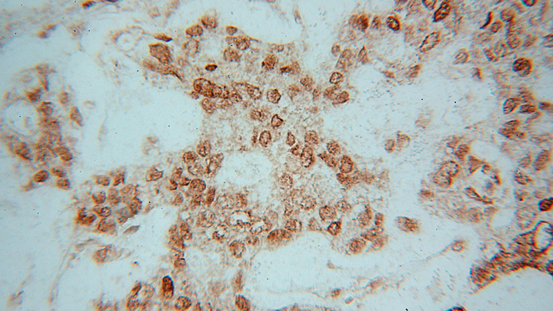 Immunohistochemical of paraffin-embedded human breast cancer using Catalog No:111408(HIST1H4E antibody) at dilution of 1:50 (under 40x lens)
