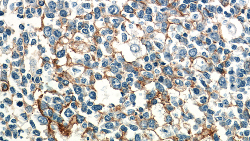Immunohistochemistry of paraffin-embedded human tonsillitis tissue slide using Catalog No:111587(ICAM-1 Antibody) at dilution of 1:50 (under 40x lens)