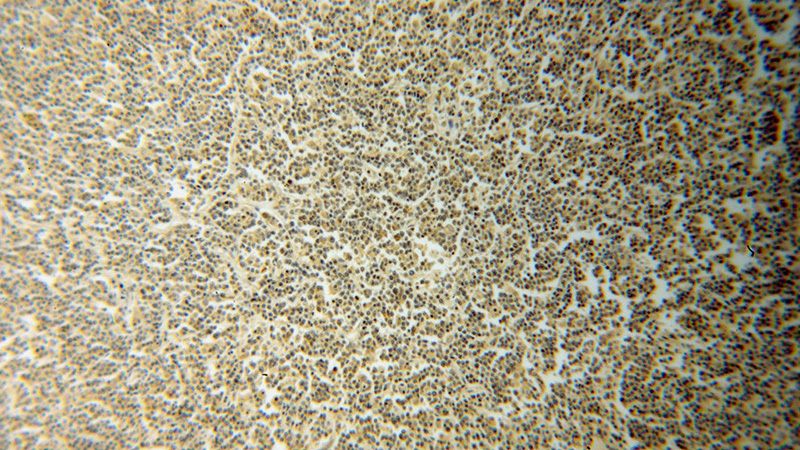 Immunohistochemical of paraffin-embedded human lymphoma using Catalog No:114826(RPS10 antibody) at dilution of 1:100 (under 10x lens)