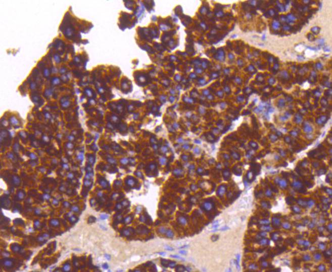Fig5:; Immunohistochemical analysis of paraffin-embedded human liver cancer tissue using anti-Sonic Hedgehog Protein antibody. Counter stained with hematoxylin.