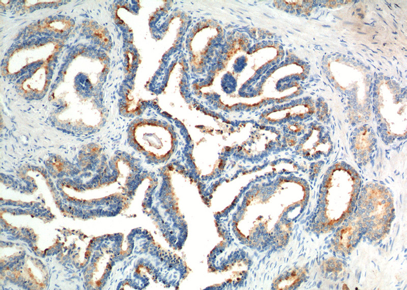 Immunohistochemistry of paraffin-embedded human prostate hyperplasia tissue slide using Catalog No:111131(GPR55 Antibody) at dilution of 1:200 (under 10x lens).