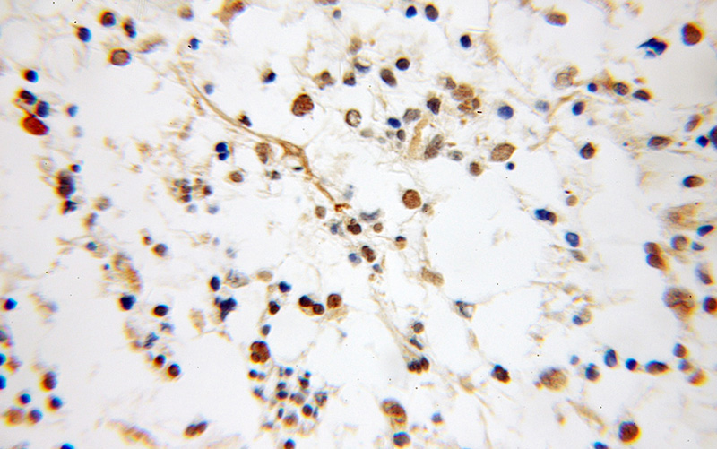 Immunohistochemical of paraffin-embedded human gliomas using Catalog No:113362(NUDT6 antibody) at dilution of 1:50 (under 10x lens)