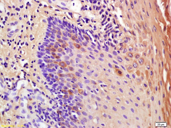 Fig1: Tissue/cell: Human oral squamous cell carcinoma; 4% Paraformaldehyde-fixed and paraffin-embedded;; Antigen retrieval: citrate buffer ( 0.01M, pH 6.0 ), Boiling bathing for 15min; Block endogenous peroxidase by 3% Hydrogen peroxide for 30min; Blocking buffer (normal goat serum,C-0005) at 37℃ for 20 min;; Incubation: Anti-IL-1RA Polyclonal Antibody, Unconjugated 1:200, overnight at 4℃, followed by conjugation to the secondary antibody(SP-0023) and DAB(C-0010) staining