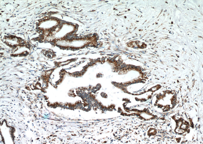Immunohistochemical of paraffin-embedded human pancreas cancer using Catalog No:111221(GRP78,BIP antibody) at dilution of 1:50 (under 10x lens)