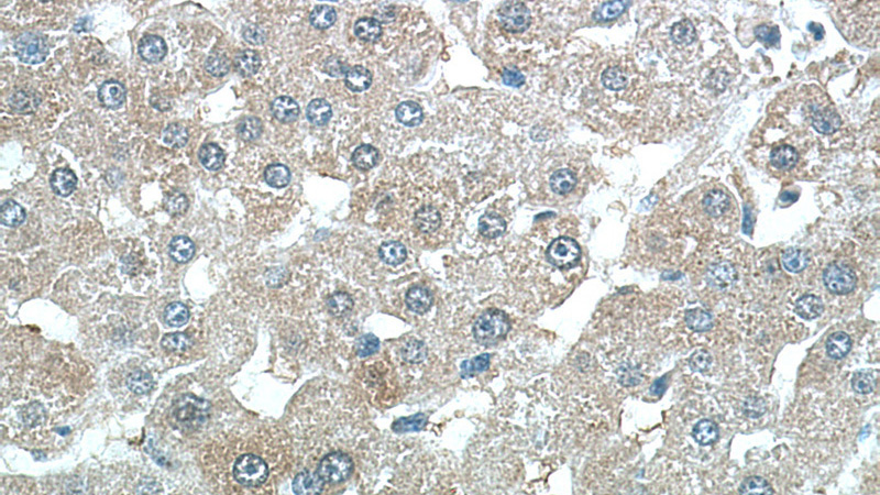 Immunohistochemistry of paraffin-embedded human liver tissue slide using Catalog No:109578(CRP Antibody) at dilution of 1:200 (under 40x lens).